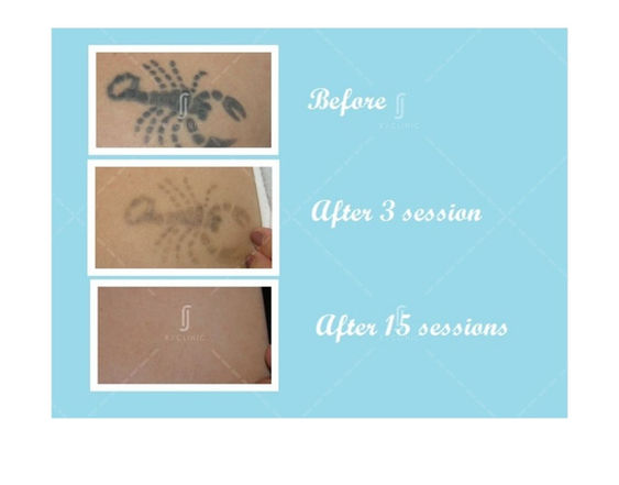 Pembuangan Tatu _ KLINIK ESTETIK RJ (10).jpg