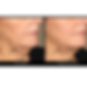 Neck Firming Treatment KL – Tighten Neck Lines | RJ Clinic