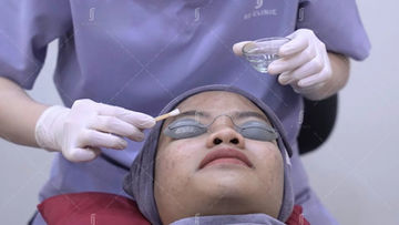 Chemical skin peel facial treatment procedure at RJ Clinic Kuala Lumpur