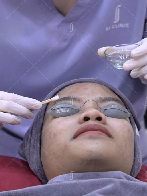 Chemical skin peel facial treatment procedure at RJ Clinic Kuala Lumpur