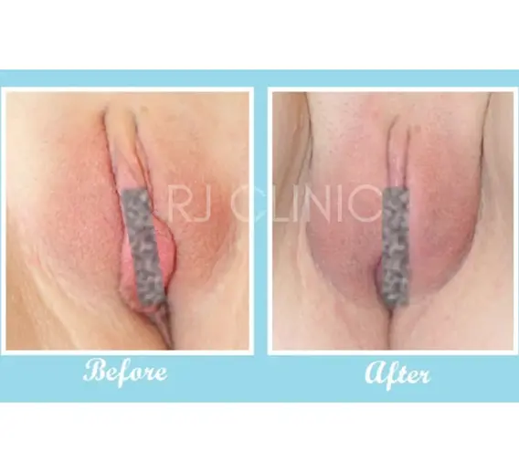 RJ Clinic's close-up labiaplasty result showing refined labial border and reduced bulkiness, photographed for medical educational use.