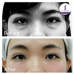 eyebag filler treatment rj clinic