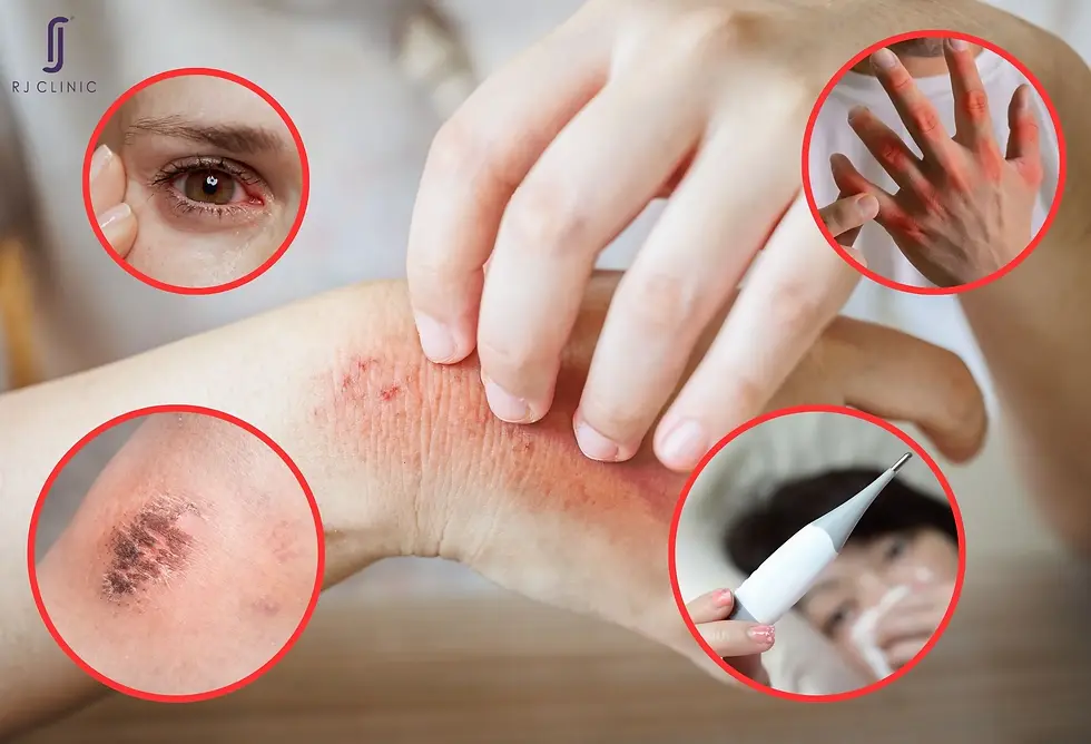 symptoms of shingles
