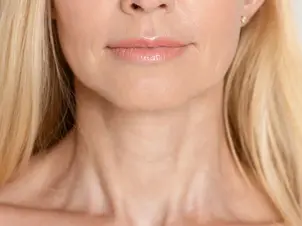neck lines of aging woman