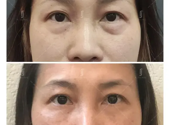 AccuSculpt laser treatment for eye bag fat reduction