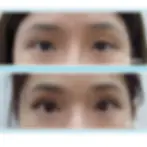 Before and after results of double eyelid suture using RJ Clinic’s Modified 4 Suture technique