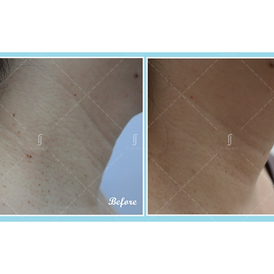 MOLE REMOVAL BY RJ AESTHETIC CLINIC