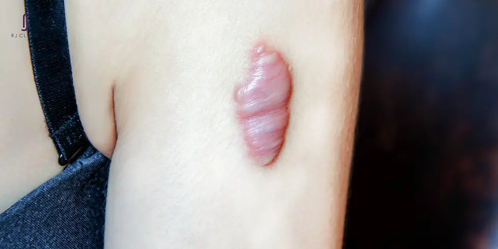Close-up view of raised keloid 
scar tissue on skin