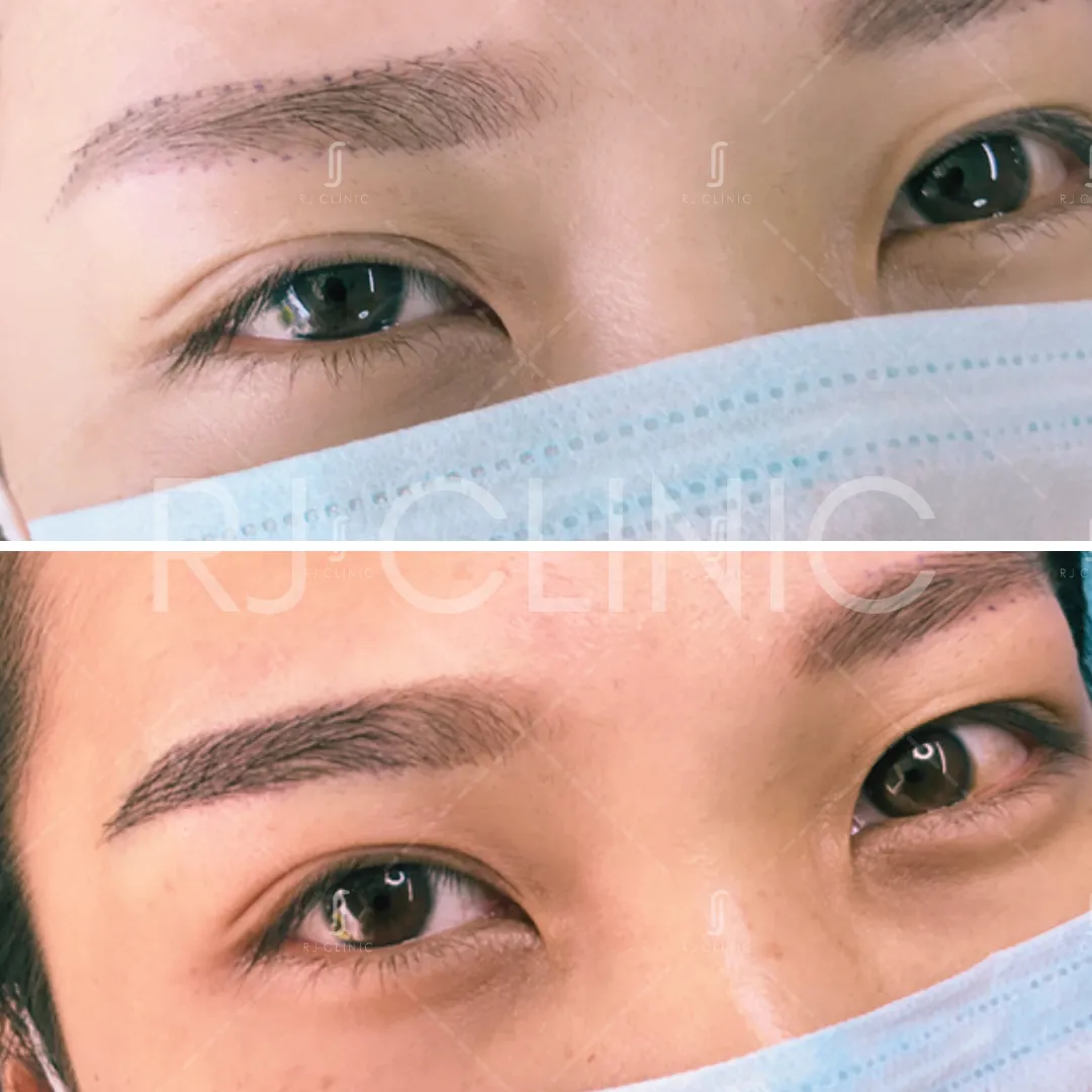 Before after results of fue eyebrow transplant