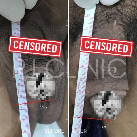 Penile augmentation filler before and after with measurement proof