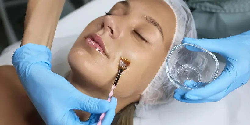 what to expect chemical peel treatment