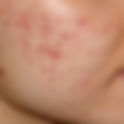 Acne & Acne Scars Treatment Malaysia | RJ Clinic