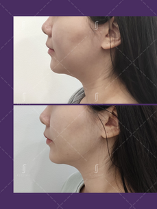 Acculift Face Slimming Laser Lipolysis Before After Results | RJ CLINIC