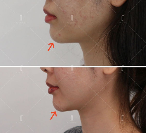 Chin filler treatment done at RJ Clinic