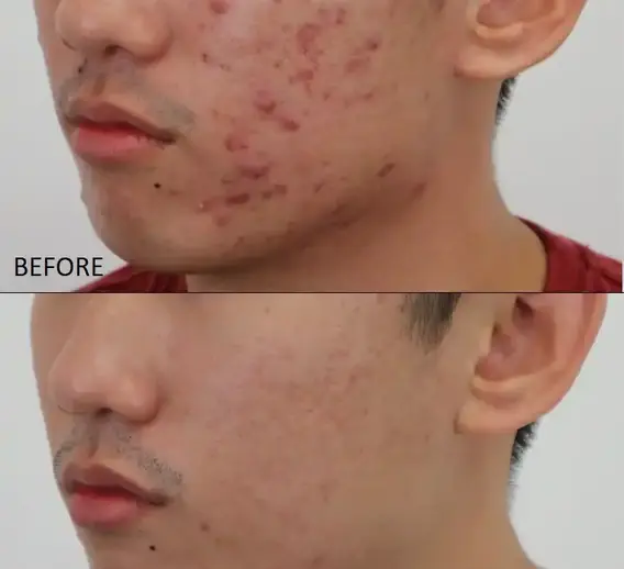 Improved skin texture after glycolic acid peel
