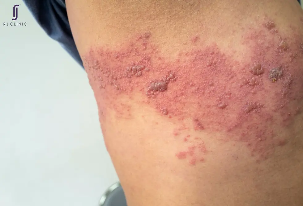how shingles look like on the skin