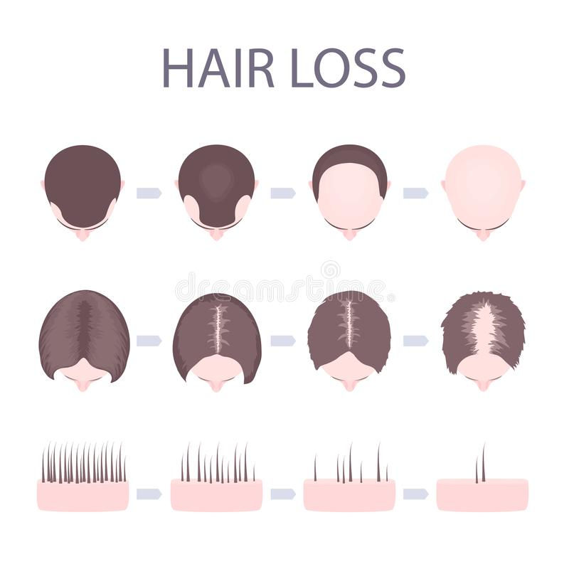 rj clinic hair loss types in male females