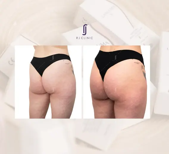 Lanluma treatment – upper outer hip dip correction, before/after comparison