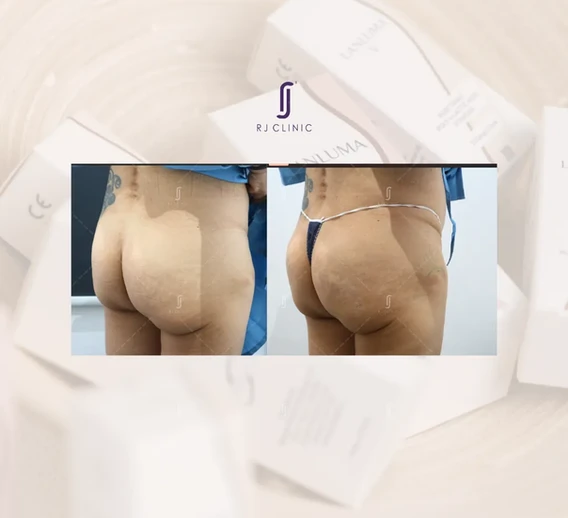 Lanluma hip dips filled – gluteal symmetry improvement, before and after