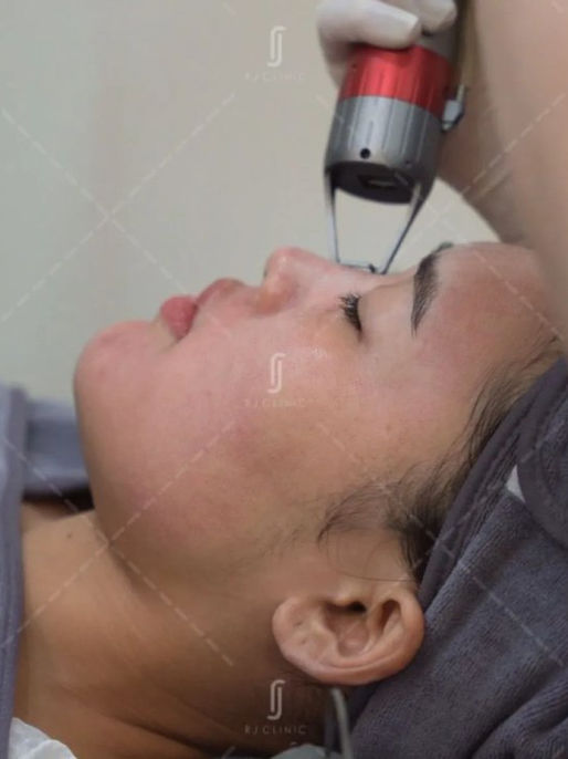 RJ Clinic skin tightening laser treatment in TTDI
