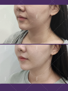 Acculift Face Slimming Laser Lipolysis Before After Results | RJ CLINIC