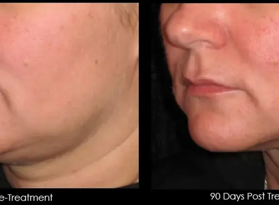 Before and after chin tightening with Ultherapy Prime Malaysia
