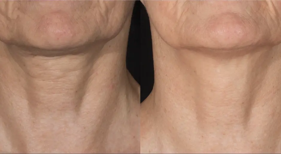 Before and after Potenza RF microneedling for neck skin tightening and texture improvement