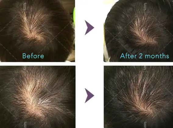 Hair regrowth result using 5% minoxidil with dermomine hair stem cell