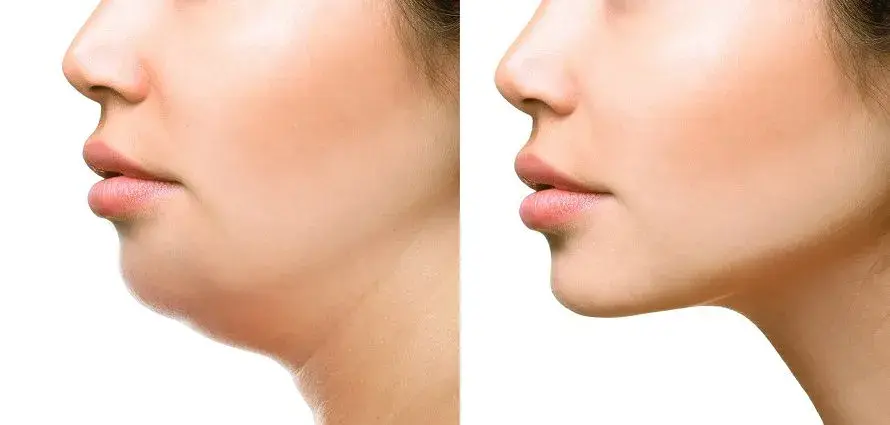 Double chin before after result after face slimming