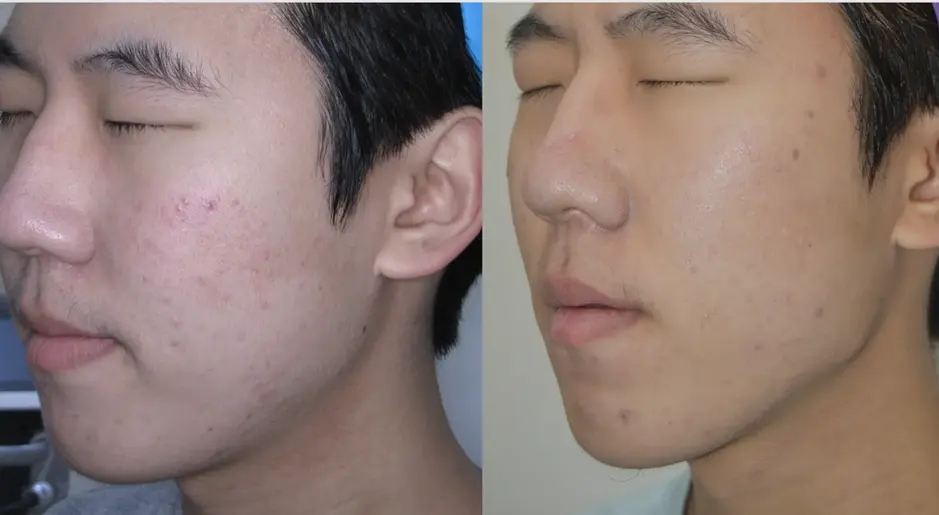 Before and after Potenza RF microneedling for active acne and post-acne marks