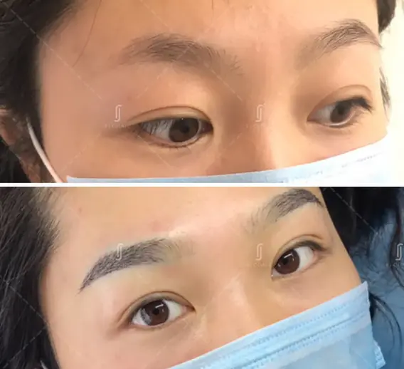 rj 诊所 Instabrow 眉毛移植前后效果 18