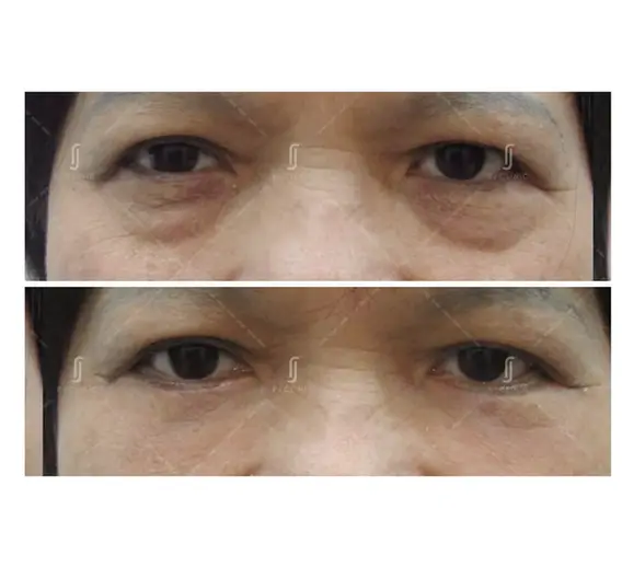 Natural-looking outcome after lower eyelid surgery in Malaysia – female patient with improved eye contour and youthful appearance.