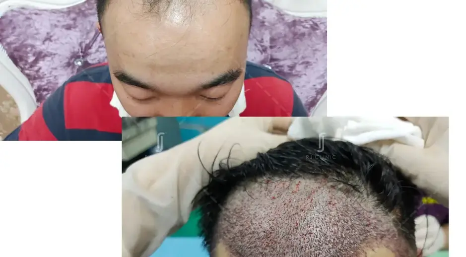 Early stage hair loss treated with FUE hair transplant in Malaysia