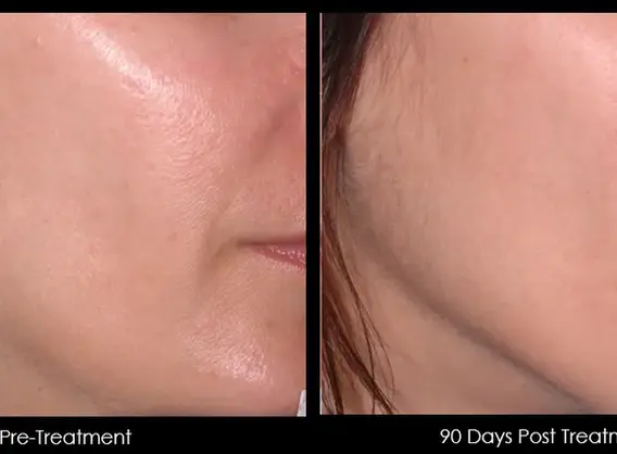 Non-surgical cheek lift using Ultherapy in Kuala Lumpur