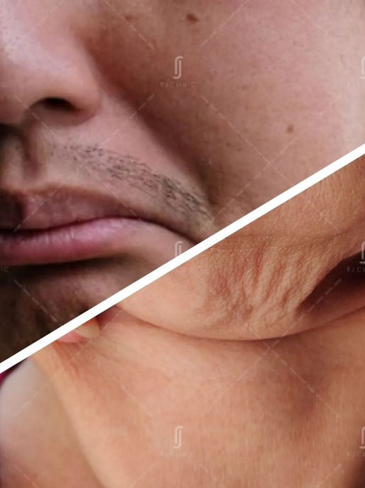 Face Fat vs. Sagging Skin: A Doctor’s Guide to Facial Contouring in Kuala Lumpur