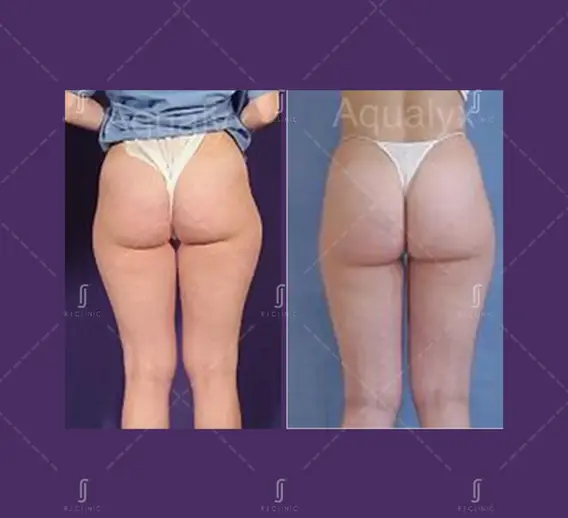 Aqualyx before and after thigh fat reduction treatment