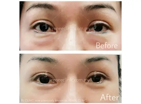 Before and after fat removal for severe eye bags