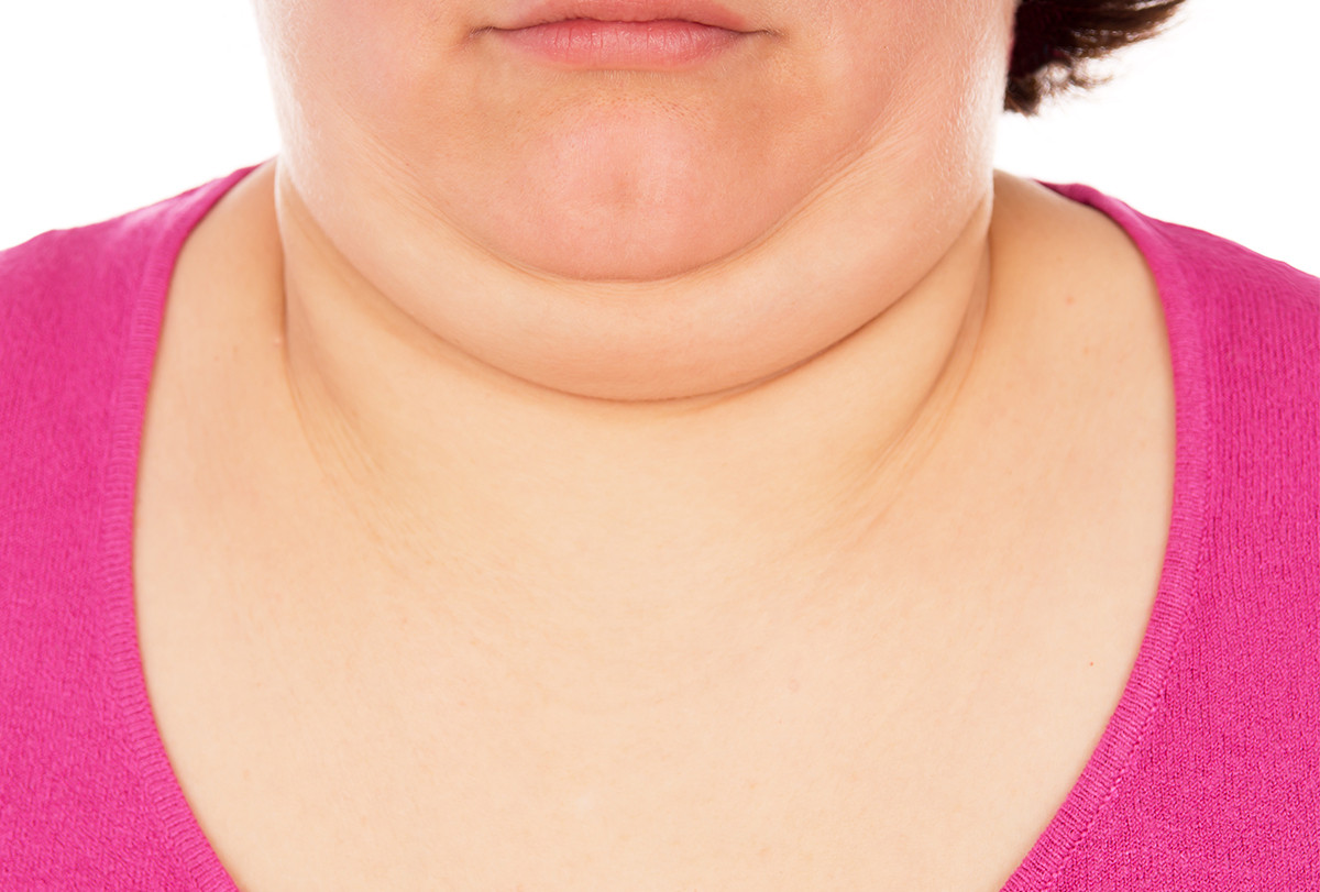 double chin reduction beverly hills