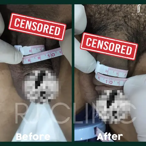 Girth enhancement using HA filler – before and after photos