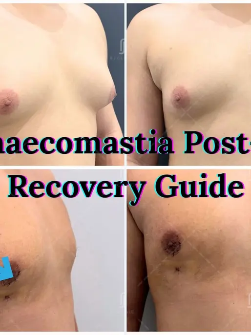 Gynaecomastia post-op recovery guide at rj clinic