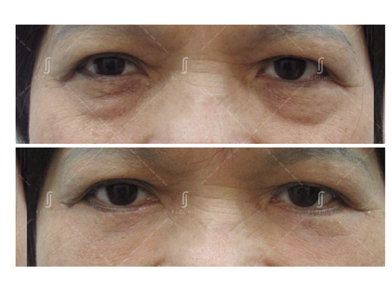 Vibrant Eye Bag Operation Background Photography Vibrant Eye Bag Operation Background Photography