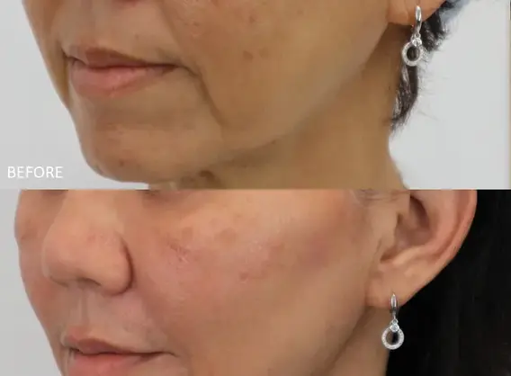 Face contour tightening with Ultherapy Prime – RJ Clinic KL
