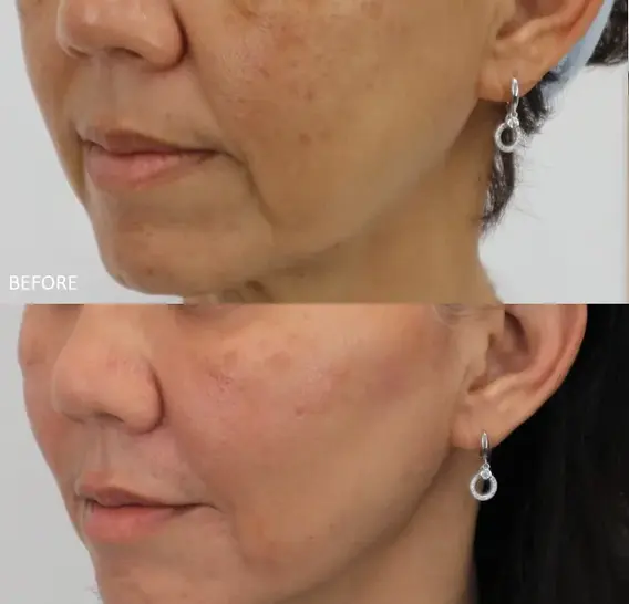 使用Ultherapy Prime紧致面部轮廓 – RJ Clinic KL
