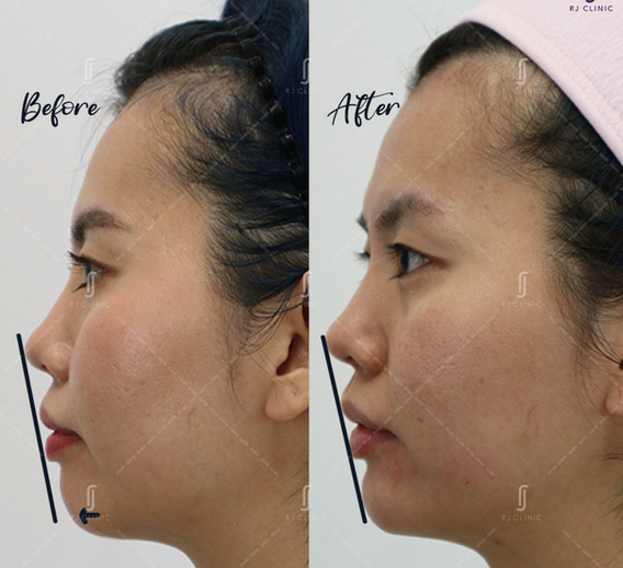 Chin filler treatment done at RJ Clinic