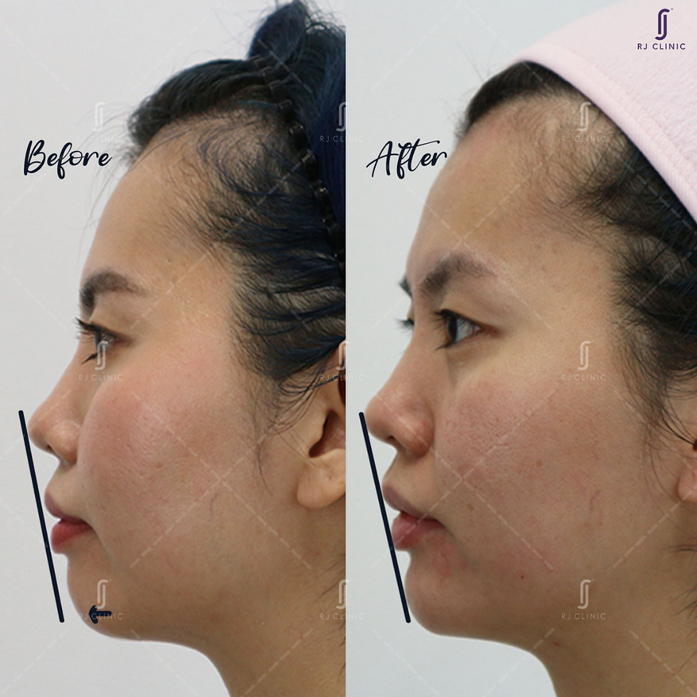 before after chin filler result