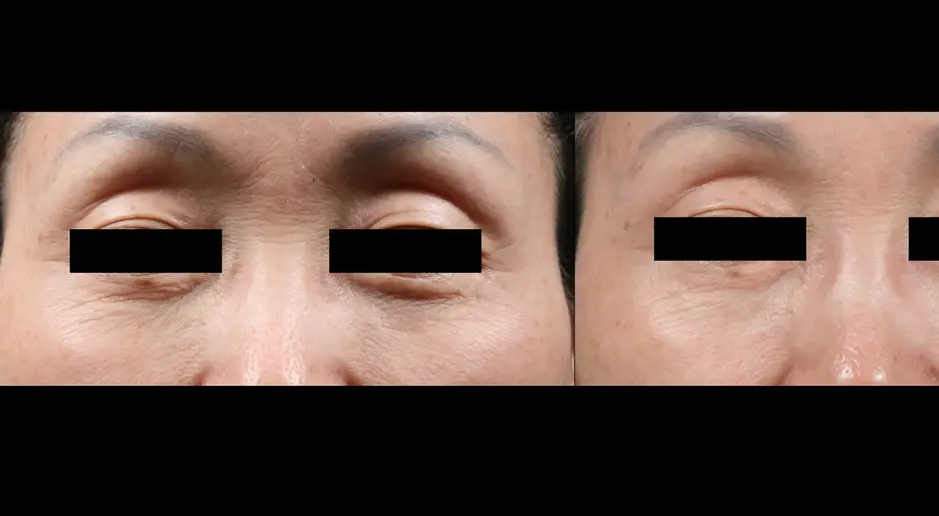 Before and after Potenza RF microneedling for fine lines and skin texture around the eyes