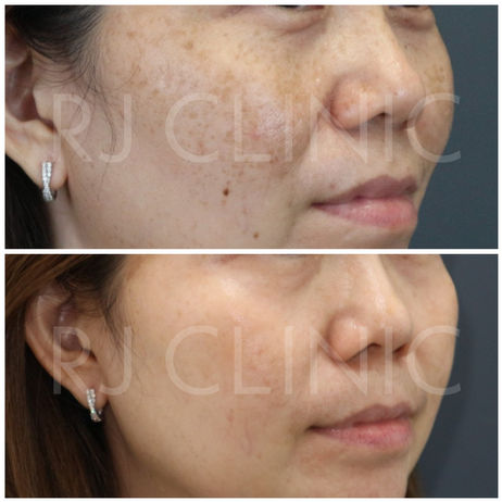Rawatan melasma sebelum selepas di klinik RJ 6