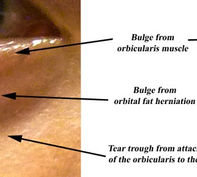 Eye bags: To Zap it or to Cut it?