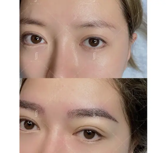 rj 诊所 Instabrow 眉毛移植前后效果 4