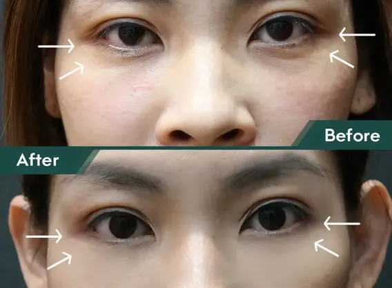 Ultherapy Prime results for eyebrow and forehead lifting